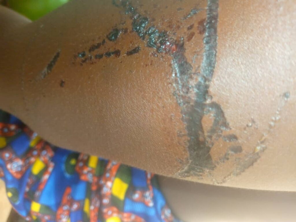 Kindia: Une femme victime de graves violences conjugales à Sokia dans Bangouya   