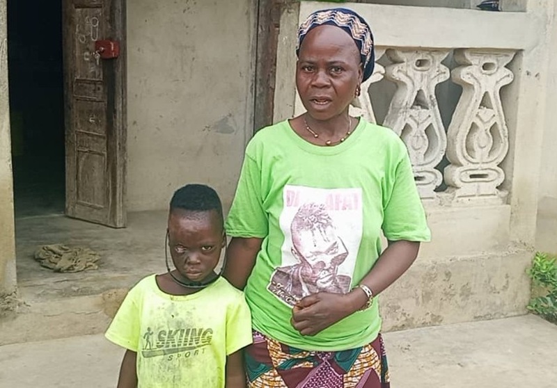 Yomou : SOS en faveur du petit Pépé Kpoghomou victime de brulures
